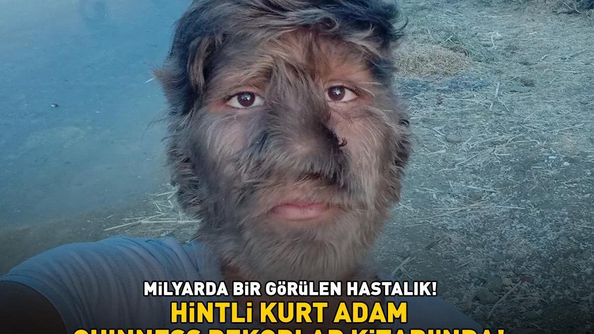 Hintli kurt adam Guinness’e girdi! Milyarda bir görülen hastalık! Yüzünün yüzde 95’i…